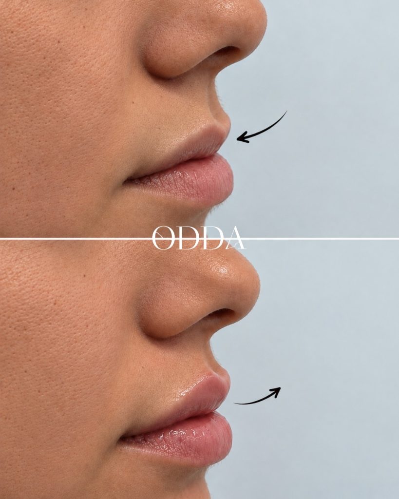 Aumento de labios con ácido hialurónico, Clínica ODDA Barcelona