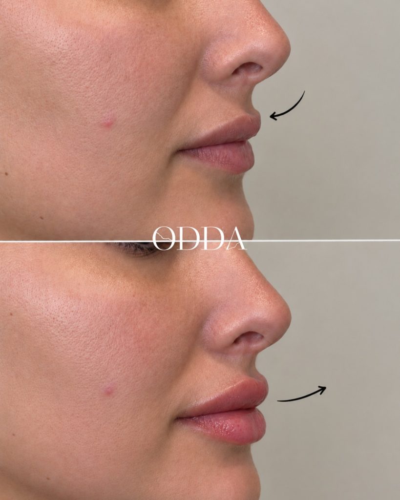 Labios con ácido hialurónico, antes y después, Clínica ODDA Barcelona