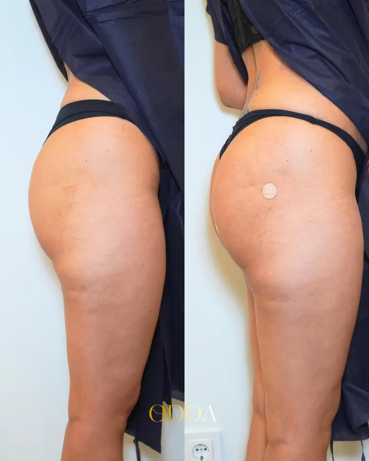 Flacidez de glúteos, caso 1, vista de perfil, antes y después. Clínica ODDA Barcelona
