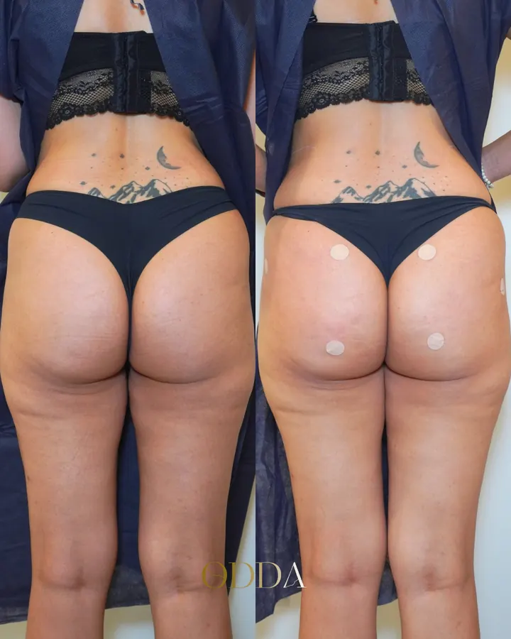 Flacidez de glúteos, caso 1, vista posterior, antes y después. Clínica ODDA Barcelona