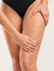 Celulitis en el muslo, zona a tratar con subcisión